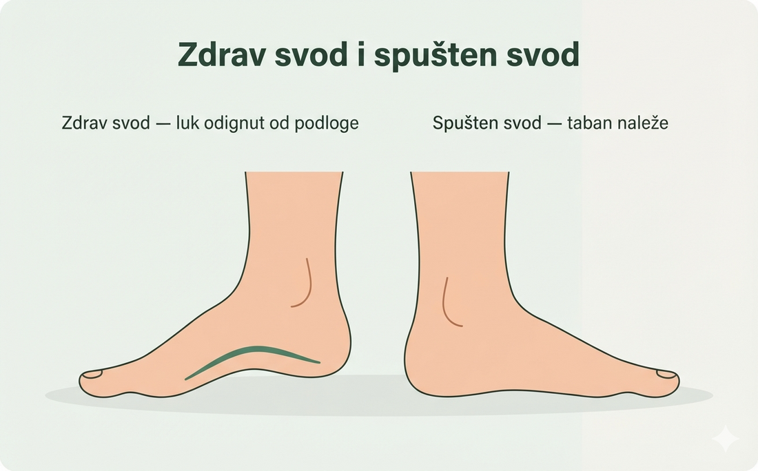 Poređenje zdravog svoda i spuštenog svoda stopala